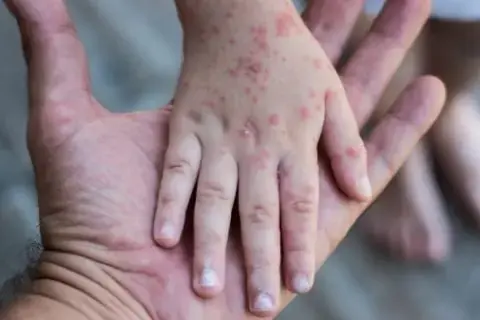 Спалах вірусу Коксакі на Київщині: захворіли 13 дітей