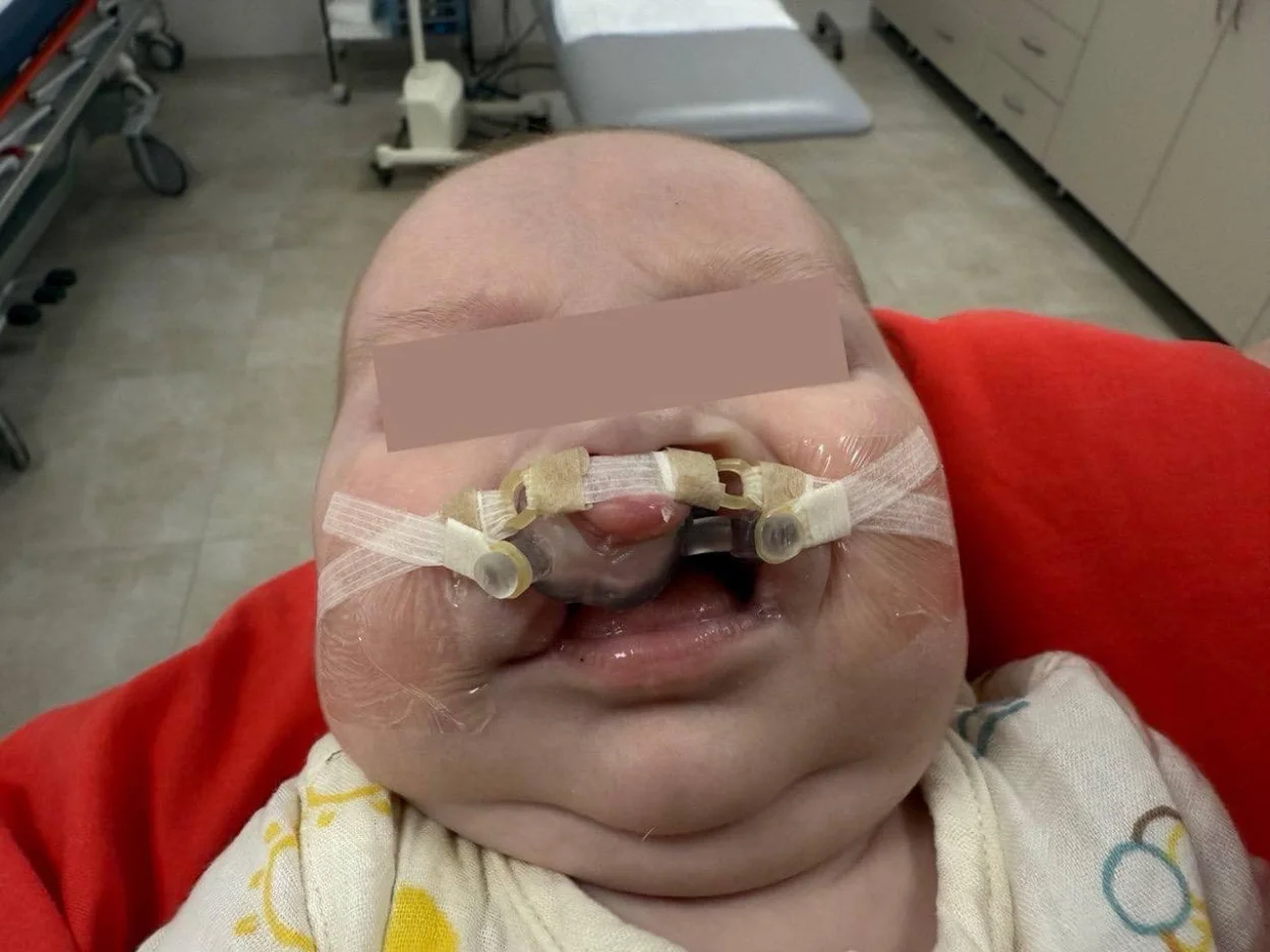 В Івано-Франківську провели унікальну операцію малюку, яка отримала світове визнання